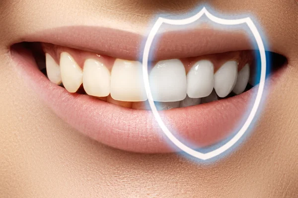 Sorriso perfetto prima e dopo la decolorazione. Cura dentale e sbiancamento dei denti. Stomatologia e cura della bellezza. Donna sorridente con grandi denti. Sorriso femminile allegro con sci fresco e chiaro — Foto Stock