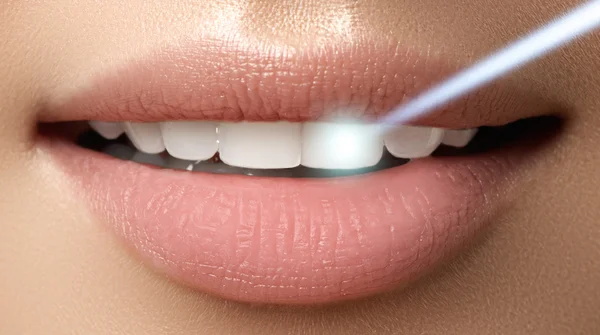 Perfect smile after bleaching. Dental care and whitening teeth. Laser teeth whitening — Stock Photo, Image