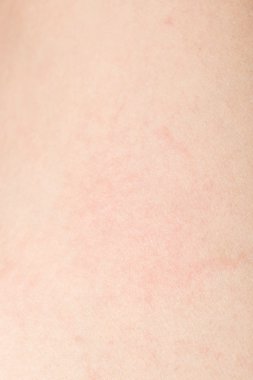 İnsan cilt dokusunu sağlıklı bel için ciltte siyah kıllar ile