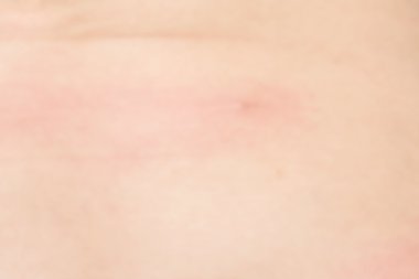 Yumuşak odak Anti göbek için insan sağlıklı cilt kavramı üzerinde