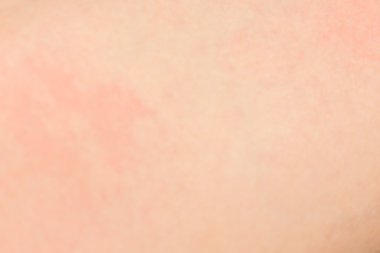 İnsan cilt dokusunu alerji ile arka plan bulanık
