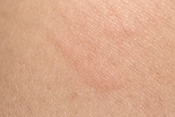 Textura da pele humana com pêlos pretos na pele para costas saudáveis — Fotografia de Stock