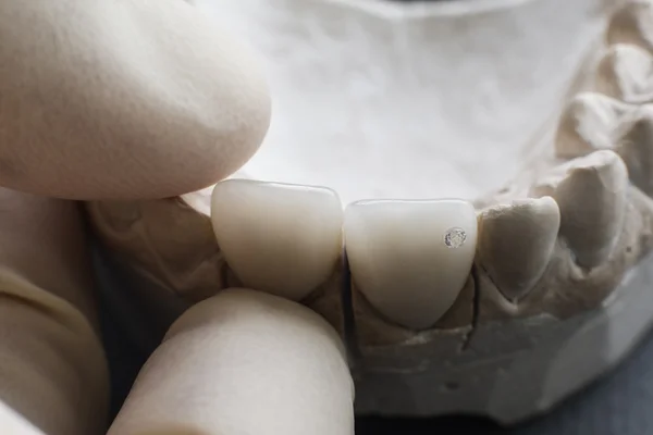 Стоматолог устанавливает керамические зубные протезы на гипсовую челюсть — стоковое фото