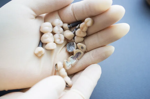 Different kinds of dentures in doctors hands — Stock Photo, Image