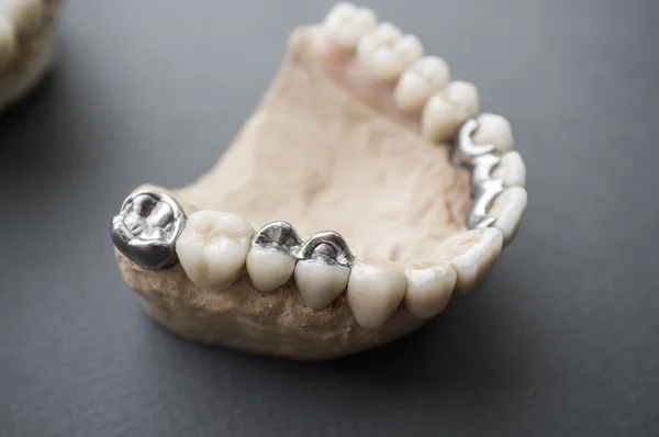 Розкладка щелепи людини з керамічними та металевими зубними протезами — стокове фото