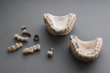 İnsan jaws, Diş implantları ve kron düz