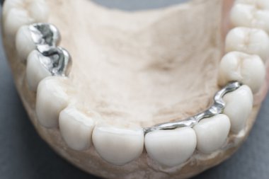 Alçı çene seramik protezler closeup ile