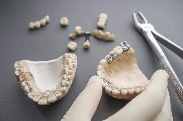 Οδοντίατρος χέρι λαμβάνοντας σαγόνι σοβά με οδοντοστοιχίες — Φωτογραφία Αρχείου