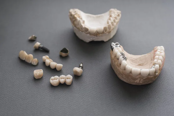 Materiales de práctica de prótesis dentales de cerca —  Fotos de Stock