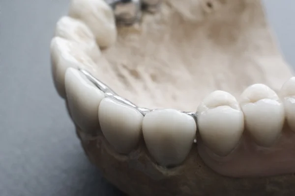Керамічні зубні імплантати на гіпсовому компонуванні крупним планом — стокове фото