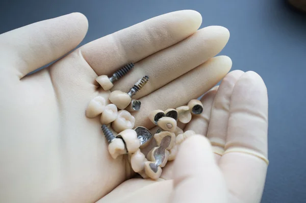 Dentista manos sosteniendo dentaduras postizas y coronas primer plano —  Fotos de Stock