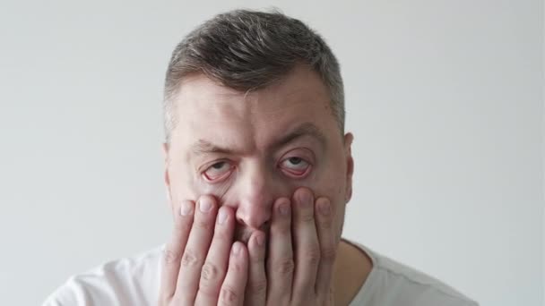 Ранкове похмілля втомлений чоловік перевіряє обличчя — стокове відео