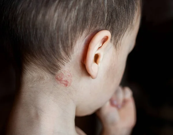 Zona ya da bir çocuğun boynundaki mantar enfeksiyonu..