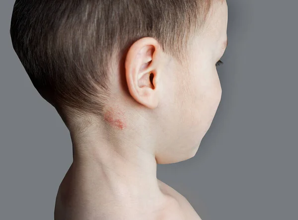Shingles or a fungal infection on the neck of a child.