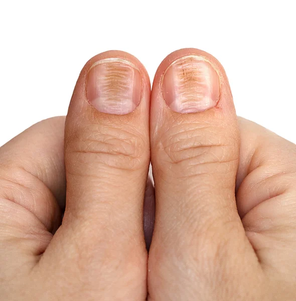 Doença das unhas, beribéri — Fotografia de Stock