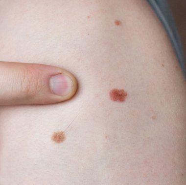 İnsan derisi üzerinde köstebek