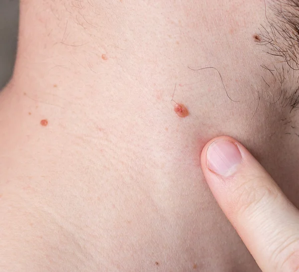 Mole on human skin — Stock Photo, Image