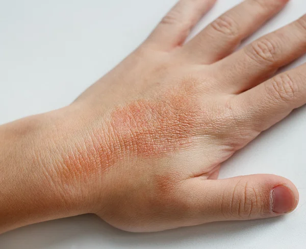 Rote Flecken auf der Haut der Kinderhände, die mit Feuchtigkeitscreme bedeckt sind. Ursache sind winterliche Kälte und Windverhältnisse. hellgrauer Hintergrund. — Stockfoto