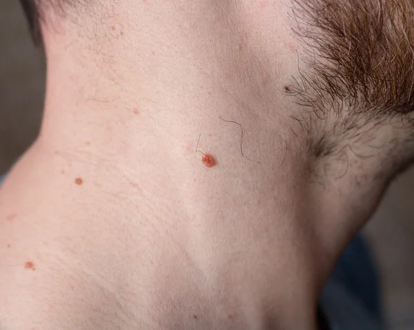 Maulwurf auf der menschlichen Haut — Stockfoto