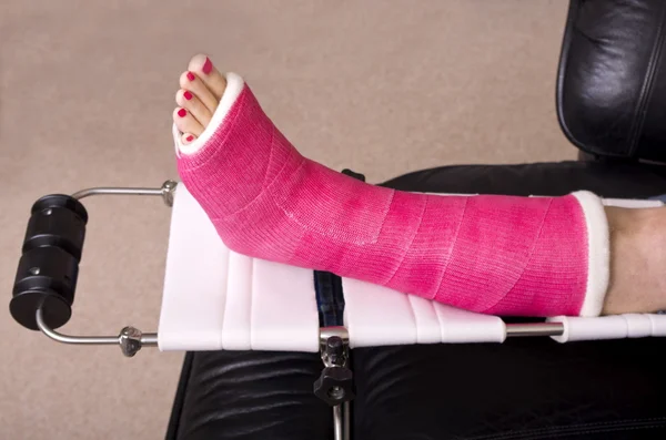 Signora con gamba fratturata — Foto Stock