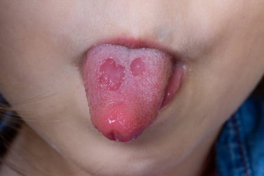 Çocuğun ağzında aftalin ülseri var. Amfotoid mide iltihabı. Dilin Candiasis 'i. Dilinde ülser var.. 