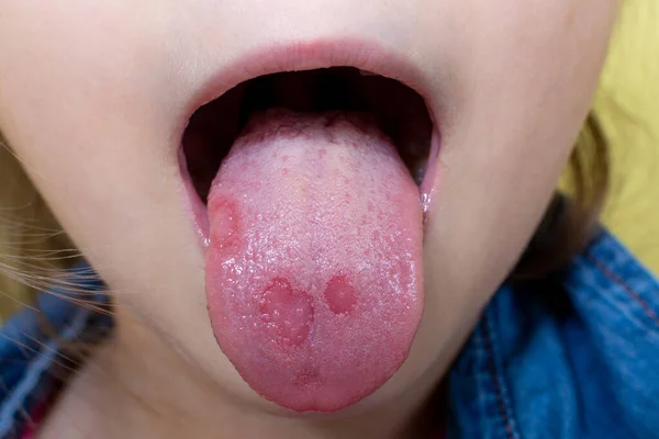 Chico Tiene Úlceras Aftosas Boca Estomatitis Amfotoide Candidiasis Lengua Úlcera —  Fotos de Stock