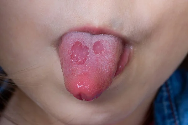 这孩子嘴上有口腔溃疡 两栖类口腔炎 舌头上的念珠菌病 舌头上的溃疡 — 图库照片