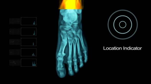 Noha pod X - Ray s jinými prvky — Stock video