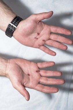 Bir sporcunun ellerinde nasırlar.