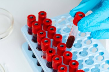 Doktorlar mavi eldiven giyer, test tüpünü kanla doldururlar.