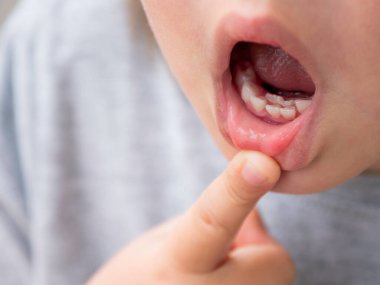 Küçük çocuk aylarında çift sıra diş gösteriyor. Azıdişleri süt dişleri dökülmeden önce büyüdü. Diş eti için diş etlerinin fotoğrafını kapat..