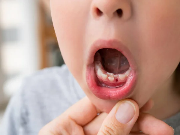 Petit Enfant Montre Une Double Rangée Dents Dans Son Mois — Photo