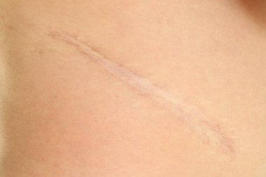 Kırk yıllık Cicatrice yarası çocukluğunda geçirdiği böbrek ameliyatından sonra yan yana geldi.