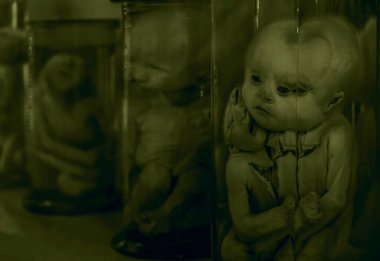 Yapışık ikizler. embriyolar, mutantlar, canavarlar Kunstkamera Müzesi, St. Petersburg, Rusya.