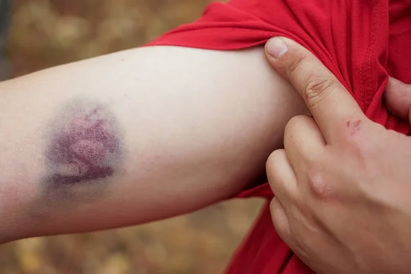 人手臂上的大块注射伤 收缩压 高加索人皮肤上的紫罗兰病变 — 图库照片