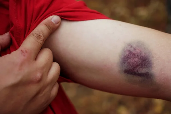 Grande Injeção Machucado Braço Homem Perto Lesão Violeta Pele Homem — Fotografia de Stock