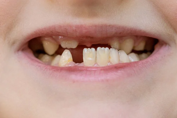 Childs mond close-up, tandgroei en gebrek daaraan Stockafbeelding