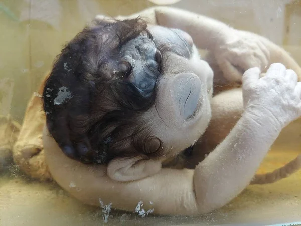Ölü doğan Anencephaly bebeği, anormal gözler, kafatası kemiği ve beyin dokuları olmayan siyah deriyle kaplı kafa derisi, bunlar çoğunlukla folik asit eksikliğinden kaynaklanıyor. Bu doğuştan gelişim bozukluğudur. Bebek formaldehit solüsyonunda korunuyor..