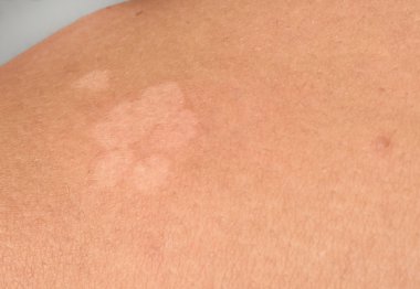 ayrıntı Cilt mantar geri