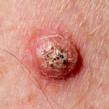 60 yaşında bir erkeğin bacağında Keratoaconthoma, iki haftalık gelişme evresi.