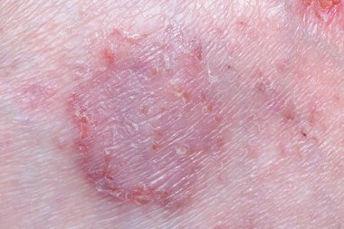 69 yaşında, Güney Afrikalı beyaz bir erkeğin ayağında egzama var.