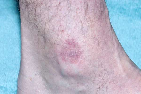 Eczema Atópico Tobillo Varón Caucásico Sudafricano Sesenta Nueve Años — Foto de Stock