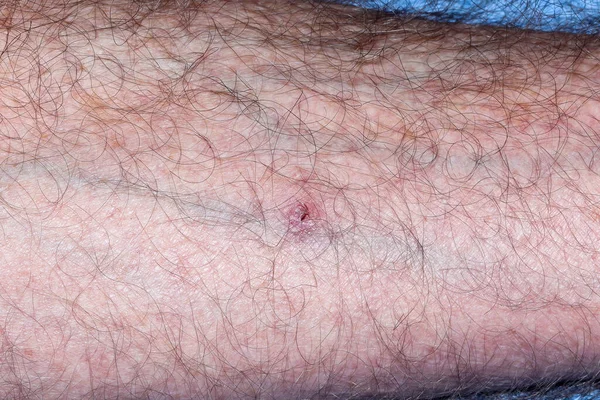 Eczema Atópico Que Resiste Tratamiento Brazo Varón Caucásico Sudafricano Sesenta — Foto de Stock