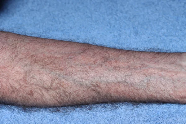 Eczema Atópico Después Tratamiento Prolongado Brazo Varón Caucásico Sudafricano Sesenta — Foto de Stock