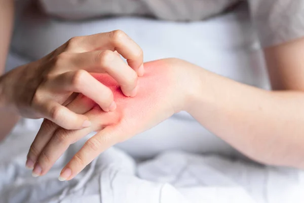 Close-up woman\'s hand scratching red rash on back of hand due to body allergy or insect bite