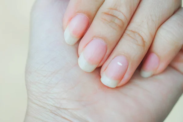 White Spots Finger Nails Called Leukonychia Reveal Emergence Health Problems — Stock Photo, Image