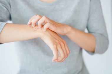 A woman scratching her arm, experiencing an allergic reaction or being stung by an insect. Skin disease concept. clipart