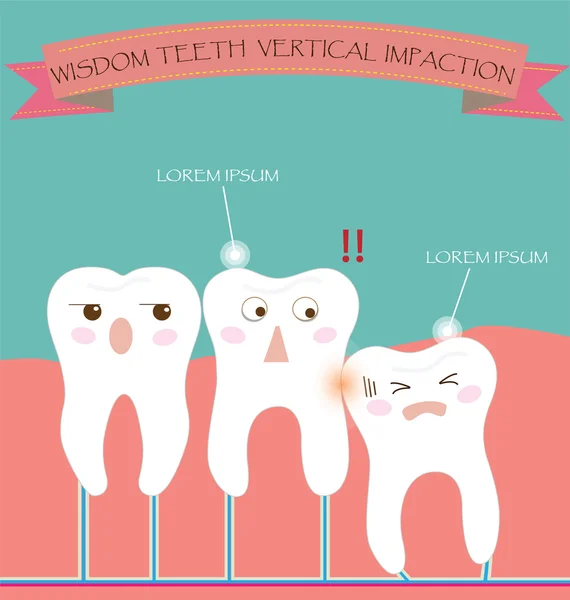 Wisdom Teeth Vertical Impaction — Stock Vector