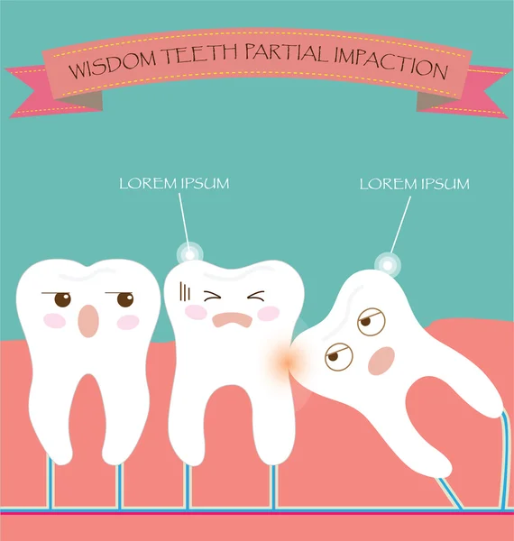 La sagesse Dents Éruption partielle Impaction — Image vectorielle