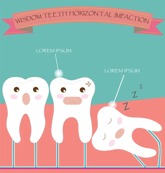 Wijsheid tanden horizontale impactie — Stockvector